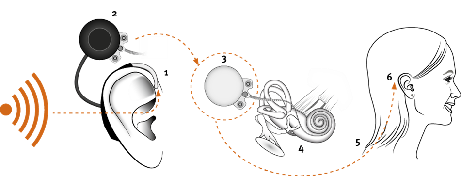 Oticon Medical Koklear Implant